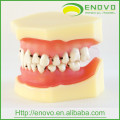 EN-L4 Peridontal Disease Dental Model with Removable Soft Gingival